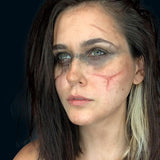 Woman  with scars after using rigid collodion